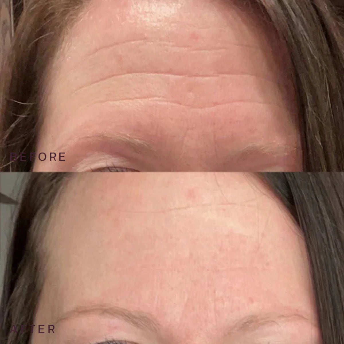Reusable Anti-Wrinkle Patches