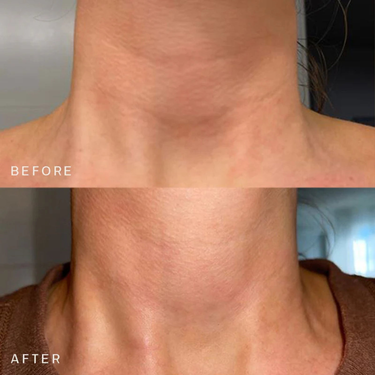 Reusable Anti-Wrinkle Patches