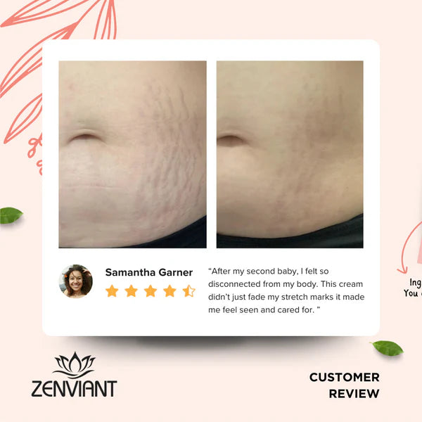 Solskin™ Stretch Mark Repair Cream